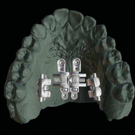 Prevalencia y necesidad de personalización en expansores MARPE: influencia anatómica y biomecánica en 120 casos planificados digitalmente