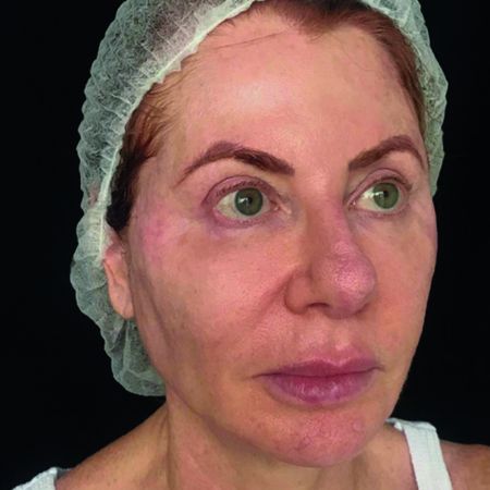 Uso de Endolift e ultrassom focado de alta intensidade para tratamento de flacidez facial severa