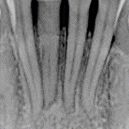 Diagnóstico e tratamento de dentes com calcificação do canal radicular: série de casos