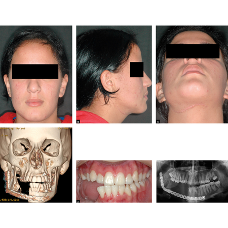 En bloc resection of central giant cell granuloma