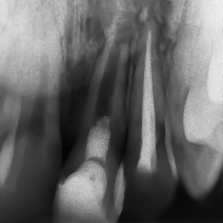 Técnica endodôntica regenerativa para dente imaturo com periodontite apical, utilizando fibrina rica em plaquetas: relato de caso