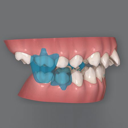 Orthodontic treatment of skeletal Class II malocclusion with severe overbite