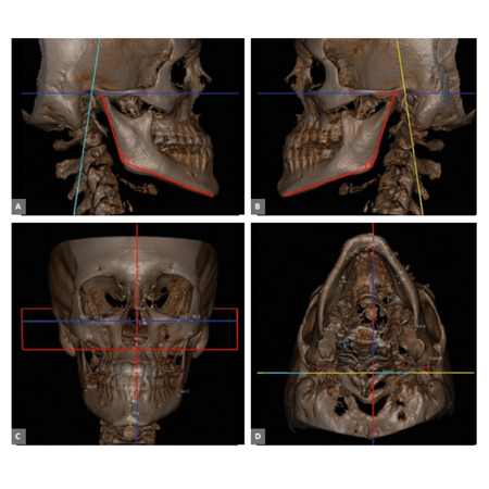 Skeletal anchorage with miniplates in surgical orthodontic preparation of skeletal Class III: case report