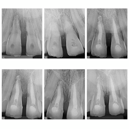 MTA as a filling option in cases of tooth resorption after avulsion: case report