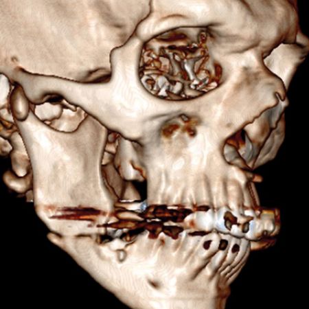 Fratura iatrogênica de ângulo mandibular e extrator: Relato de Caso