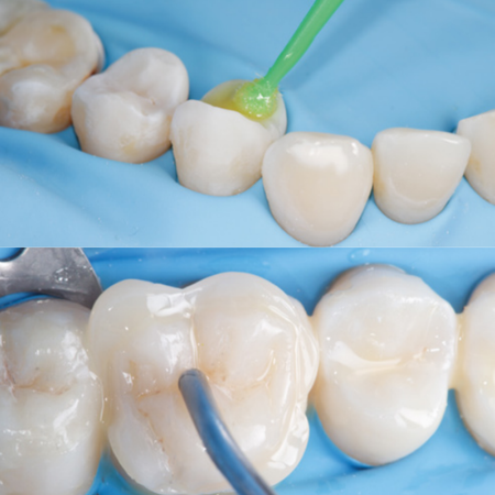 Occlusal morphology guided rehabilitation in a patient with dental erosion and loss of vertical dimension of occlusion: a clinical case report