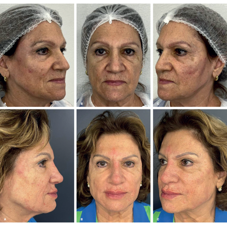 Estética regenerativa fullface em pele madura: um relato de caso