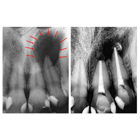 Perirradicular osteolysis of endodontic origin: immunological knowledge that every dental surgeon should have when dealing with an image of a “periapical lesion”