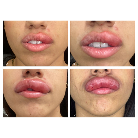 Edema angioneurótico e reação inflamatória exacerbada após uso de hialuronidase em preenchimento labial: relato de caso