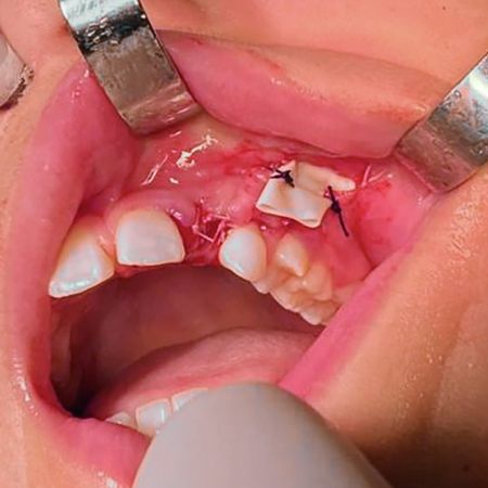 Dens in dente and facial cellulitis: case report