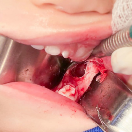 Inflammatory dentigerous cyst: case re- port in an one-year-old child