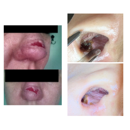 HEALING AND REGENERATIVE EFFECT OF PRF ON COMPLICATIONS OF RHINOPLASTY