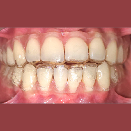 Comparative evaluation of RANKL and OPG levels in gingival crevicular fluid and saliva during orthodontic treatment using thermoformed and direct-printed aligners