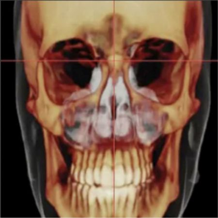 Tomographic evaluation of the cephalometric characteristics of patients with Class III malocclusion with different facial growth patterns