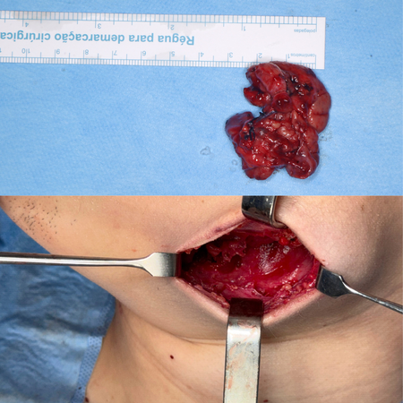 Surgical approach to submandibular plunging ranula: case report
