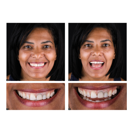 Aesthetic smile rehabilitation with ceramic crowns cemented to metal retainers opacified with composite resin: case report