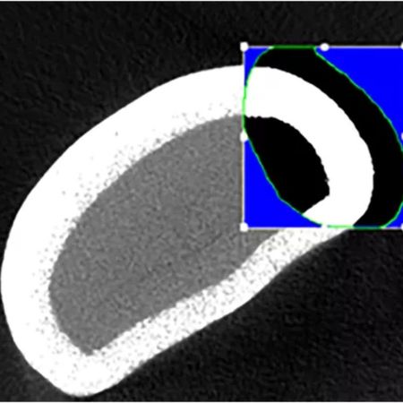 Evaluation of enamel thickness of mandibular incisors