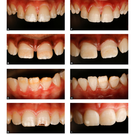 Laser de Er:YAG como Pré-Tratamento no Protocolo de Infiltração Resinosa em Dentes Hipomineralizados