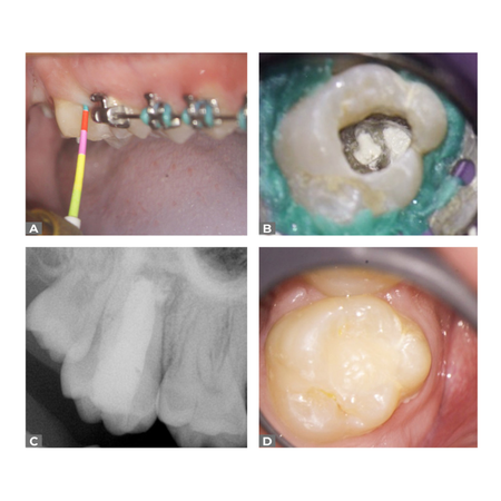 Tratamento de lesão endo-periodontal em molar superior com anatomia em C: relato de caso com acompanhamento tomográfico