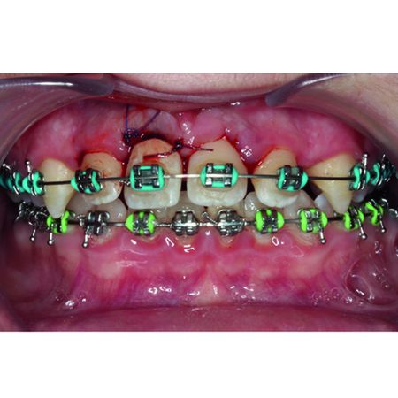 Manejo de dentes anquilosados utilizando a técnica de decoronação: revisão integrativa da literatura e relato de caso clínico