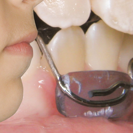 Early treatment of skeletal Class II malocclusion with functional orthopedics: stability after 15 years