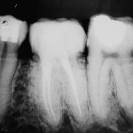 Tratamento não cirúrgico de reabsorção cervical invasiva usando cimento biocerâmico: relato de caso