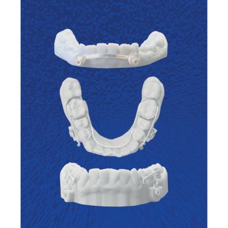 Maxillary protraction: when to use the Manhães Bar or the Manhães Bordallo Lingual Arch?