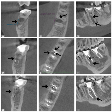 Selective endodontic retreatment of a chronic apical abscess guided by CBCT: a case report