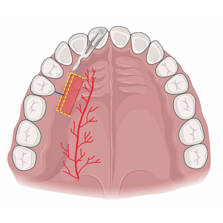 Donor site morbidity related to graft harvesting techniques: a scoping review
