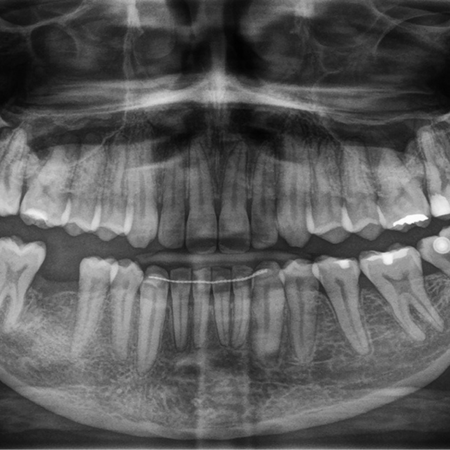 Tratamento de Classe II completa com Invisalign®: o sucesso da distalização em bloco superior sem a remoção imediata de terceiros molares