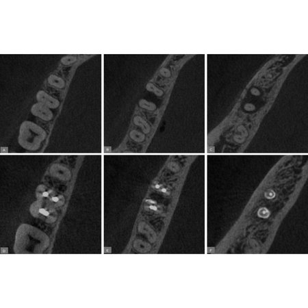 Clinical, radiographic, and tomographic success of conventional endodontic treatment: case report