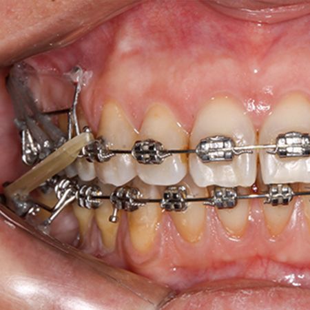 Orthodontics integrated with oral rehabilitation: case report with fiveyear follow-up