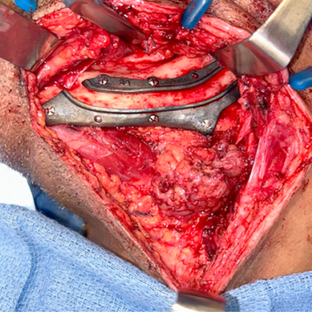 Inferior alveolar nerve reconstruction: technique description and case report