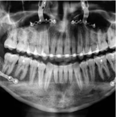 Orthodontic-surgical stability of a Class III patient: 11-year follow-up