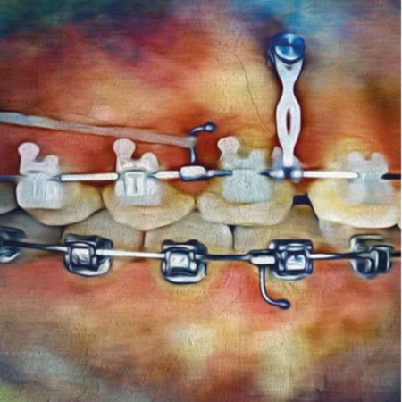 Managing Excessive Gingival Display with Maxillary Anterior Dentoalveolar Retraction, Intrusion, Miniscrews, Periodontal Surgery and Resin Veneers: Part 1