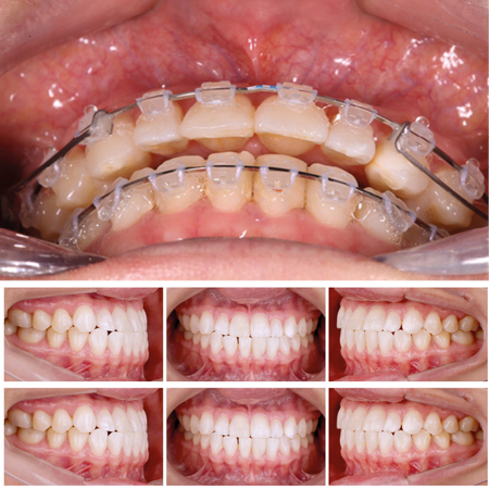 Protocol for increasing the lower anterior facial height in non-surgical adult patients. A conservative biomechanical approach with clockwise rotation of the mandible: case report