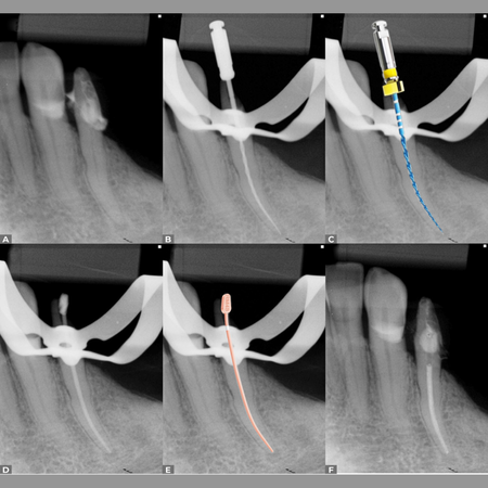 Reciproc® Minima: less wear, greater preservation, and an approach without initial scouting and without glide path