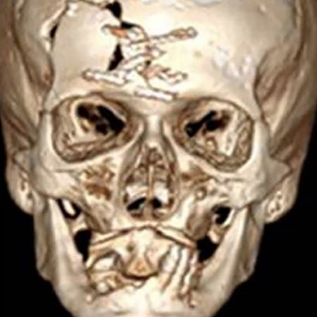 Facial trauma associated with traumatic brain injury