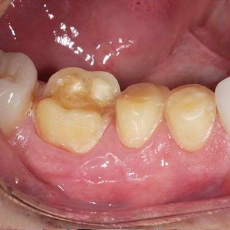 Step-by-step conservative approach for full-mouth esthetic and functional rehabilitation: case report