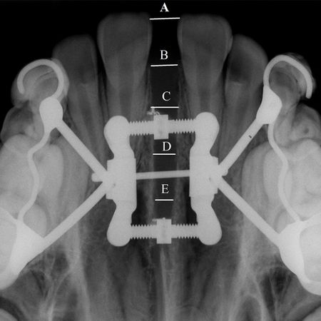 Efeitos esqueléticos imediatos da expansão rápida da maxila na abertura da sutura palatina mediana com os expansores Diferencial, Hyrax e Haas