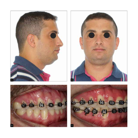 What are the intercorrelations between orthognathic surgery and OSAHS?