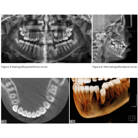 Manejo ortodóncico para incisivos fusionados asociados con dientes supernumerarios y caninos impactados: Reporte de Caso