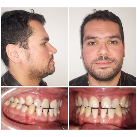 Manejo estético innovador de la maloclusión de Clase III en adultos utilizando Carriere Motion 3D Clear e Invisalign: reporte de caso