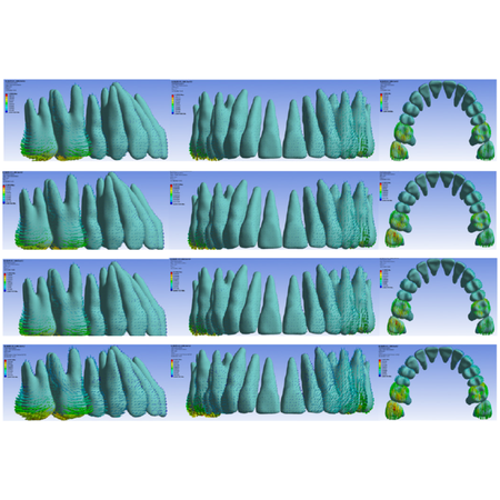 Effect of varying anchorage force intensity on upper molar distalization using clear aligners: a finite element study