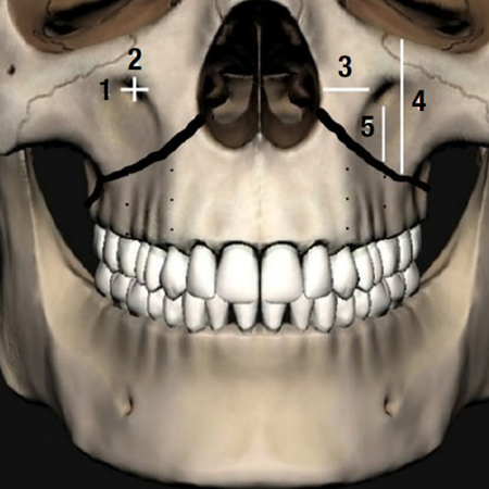 Le Fort osteotomy: should sex and height influence the design