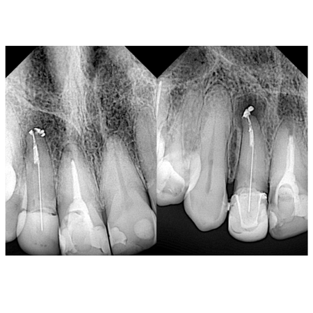Persistent infection in maxillary central incisor: case report of endodontic retreatment