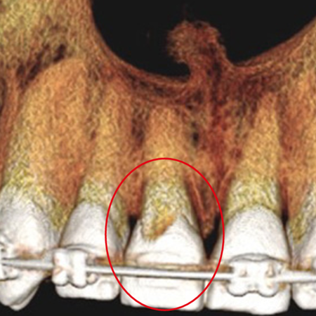 External or invasive cervical resorption? care in diagnostic imaging
