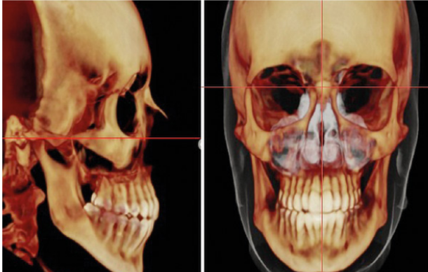 Avaliação tomográfica das características cefalométri- cas de portadores de má oclusão de Classe III com di- ferentes padrões de crescimento facial