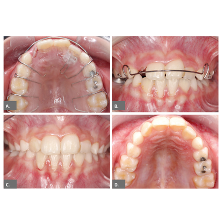 Efficient correction of dental crossbite and space management in the maxillary anterior region in a patient with mixed dentition: case report