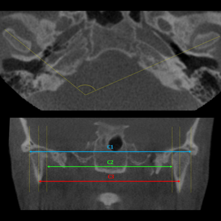 O procedimento ortodôntico-cirúrgico de avanço mandibular causa alterações no côndilo? Uma análise de série de casos